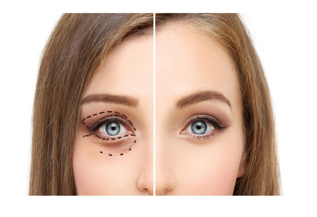 Picture2 8 - علت کوچک شدن چشم بعد از عمل بلفاروپلاستی و عوامل مربوط به آن